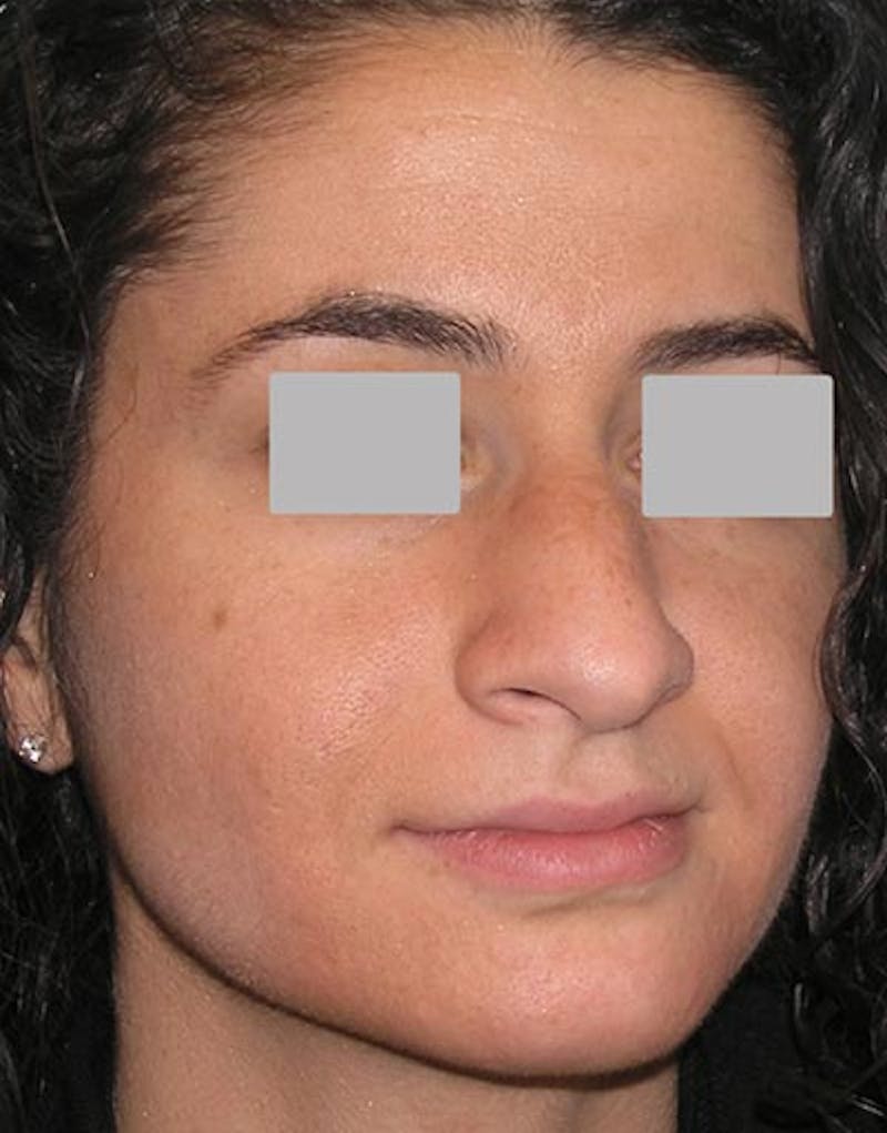 Rhinoplasty Before & After Gallery - Patient 229208 - Image 5