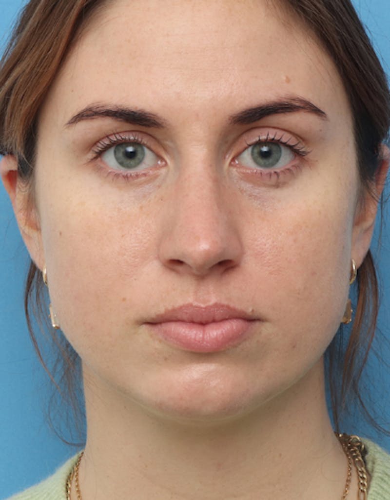 Chin Surgery Before & After Gallery - Patient 267820 - Image 3