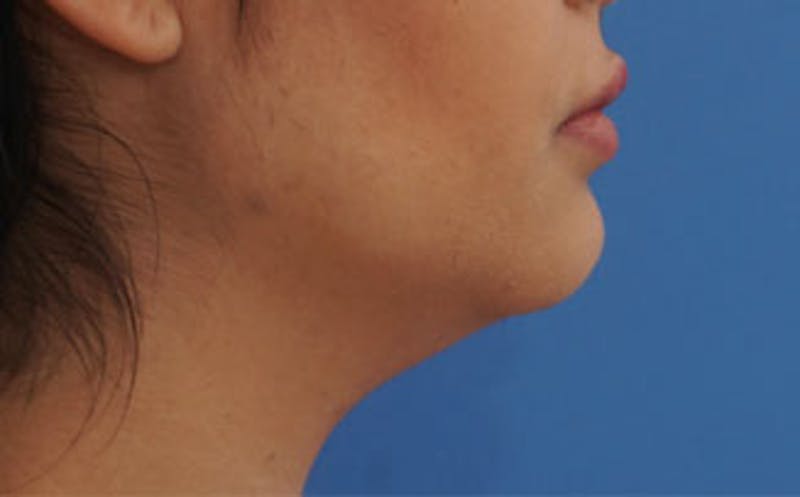 Fillers Before & After Gallery - Patient 422386 - Image 7