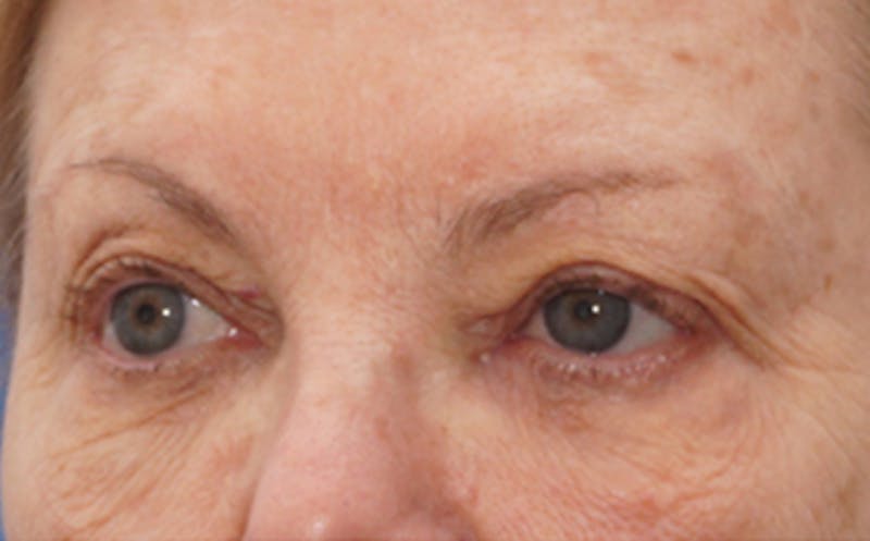 Eyelid Surgery Before & After Gallery - Patient 106125 - Image 3