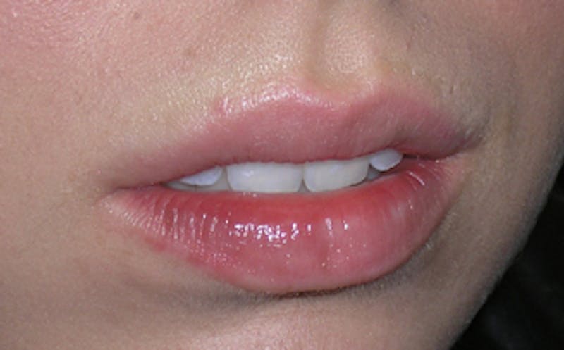 Lip Fillers Before & After Gallery - Patient 105035 - Image 5