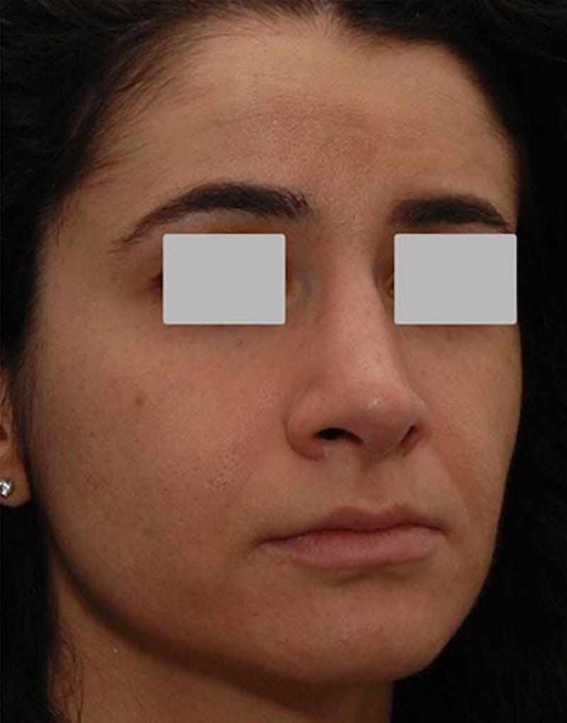 Rhinoplasty Before & After Gallery - Patient 229208 - Image 6