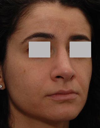 Rhinoplasty Before & After Gallery - Patient 715947 - Image 2