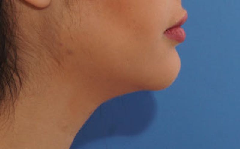 Fillers Before & After Gallery - Patient 422386 - Image 8