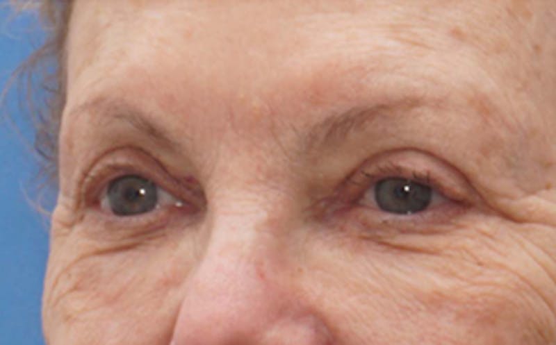Eyelid Surgery Before & After Gallery - Patient 106125 - Image 4