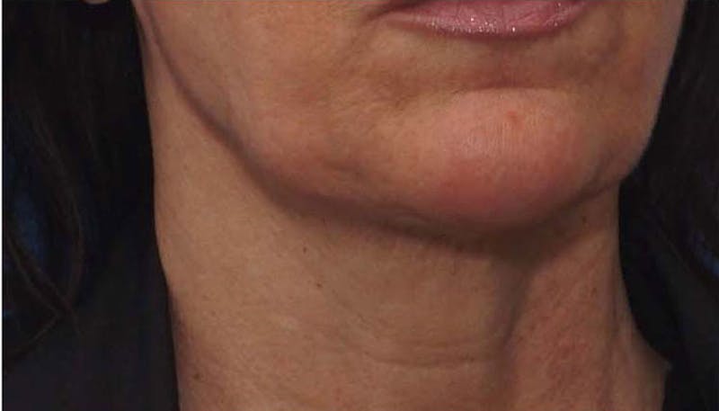 FaceTite Before & After Gallery - Patient 256615 - Image 6