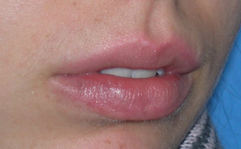 Lip Fillers Before & After Gallery - Patient 105035 - Image 6