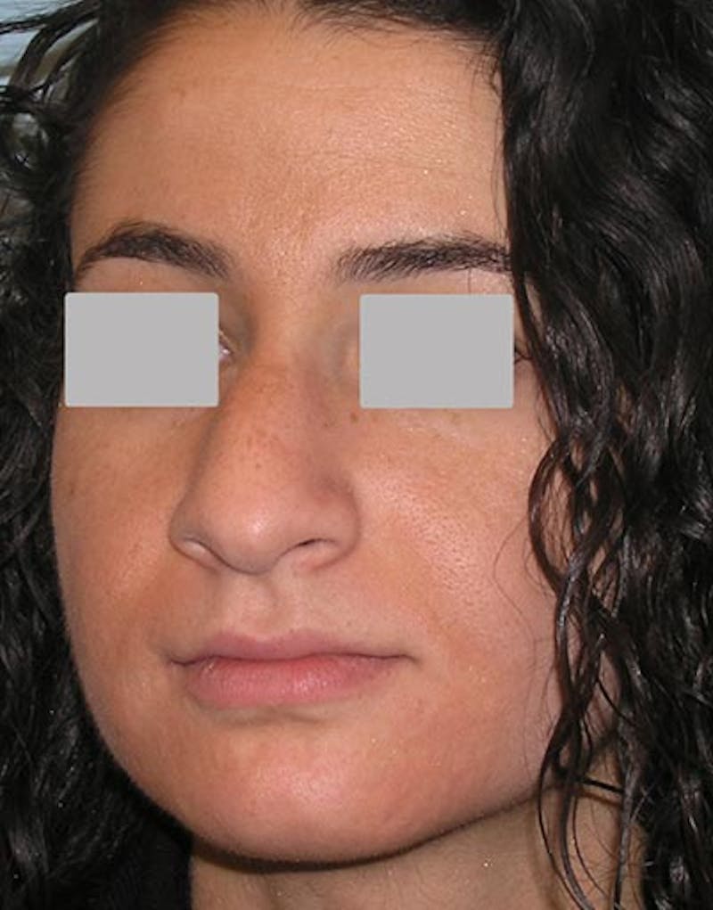 Rhinoplasty Before & After Gallery - Patient 229208 - Image 7