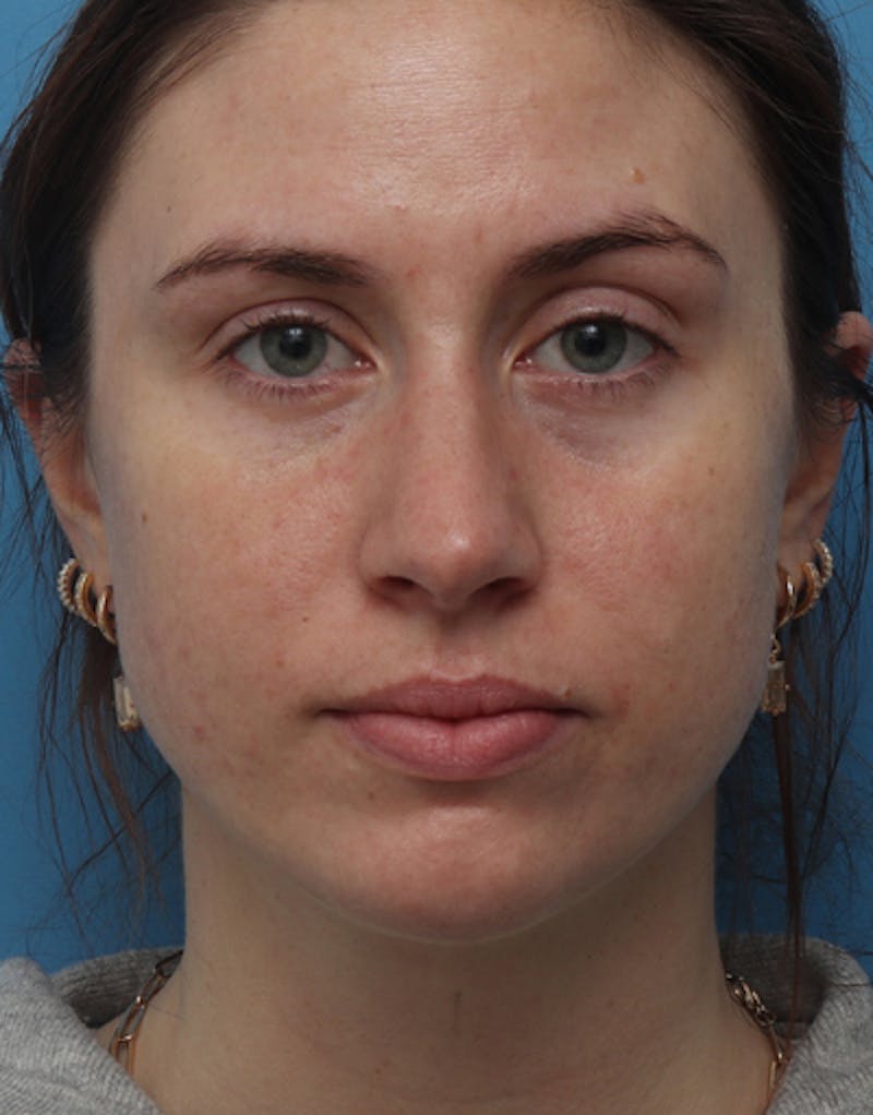 Chin Surgery Before & After Gallery - Patient 267820 - Image 4