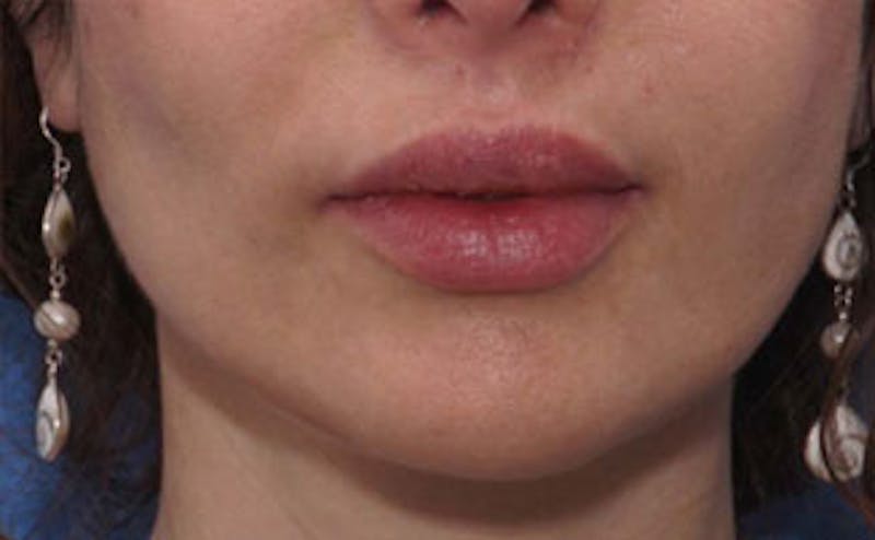 Fillers Before & After Gallery - Patient 976333 - Image 1