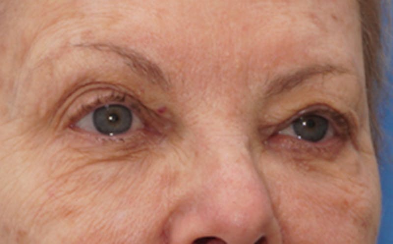 Eyelid Surgery Before & After Gallery - Patient 106125 - Image 5