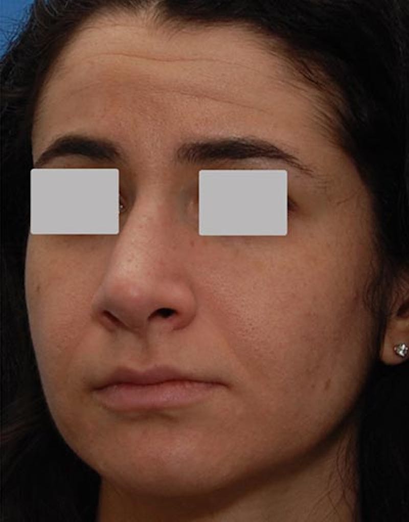 Rhinoplasty Before & After Gallery - Patient 229208 - Image 8