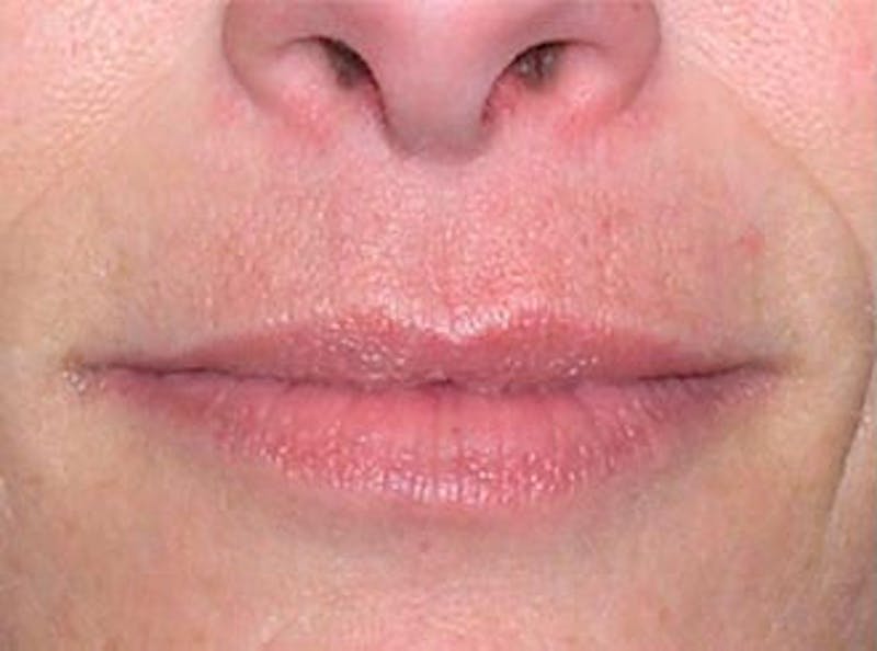 Lip Fillers Before & After Gallery - Patient 128228 - Image 1
