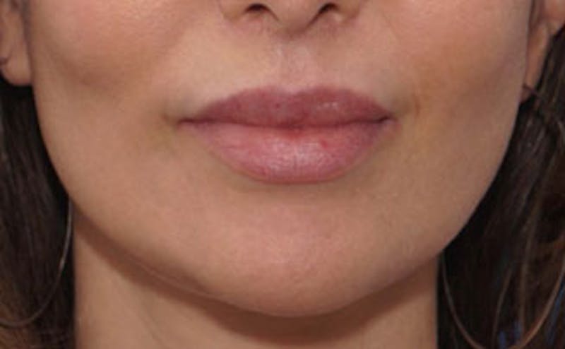 Fillers Before & After Gallery - Patient 976333 - Image 2
