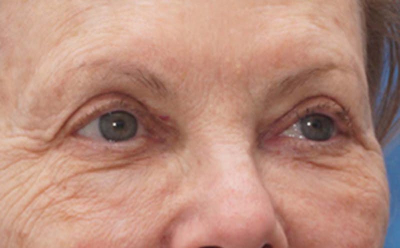 Eyelid Surgery Before & After Gallery - Patient 106125 - Image 6