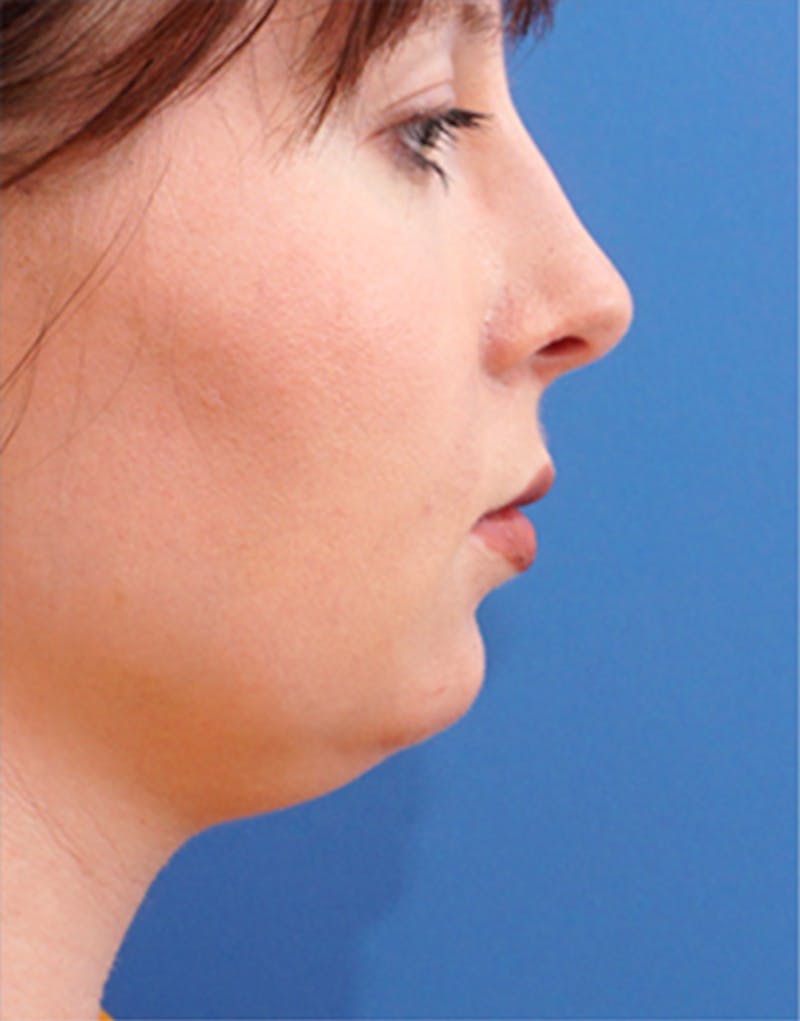Chin Surgery Before & After Gallery - Patient 194187 - Image 1