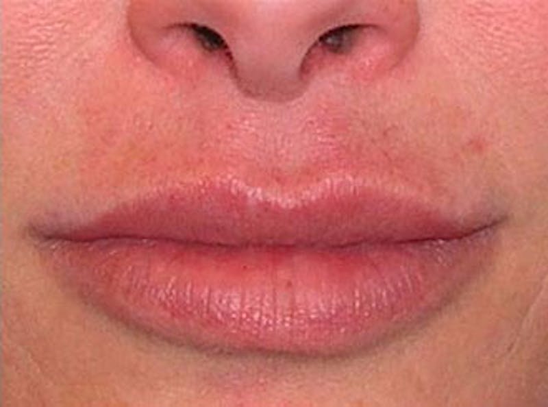 Lip Fillers Before & After Gallery - Patient 128228 - Image 2