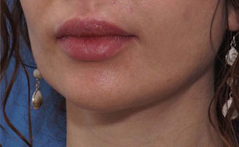 Fillers Before & After Gallery - Patient 976333 - Image 3