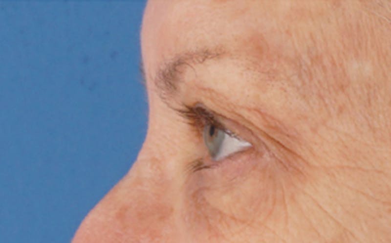 Eyelid Surgery Before & After Gallery - Patient 106125 - Image 7