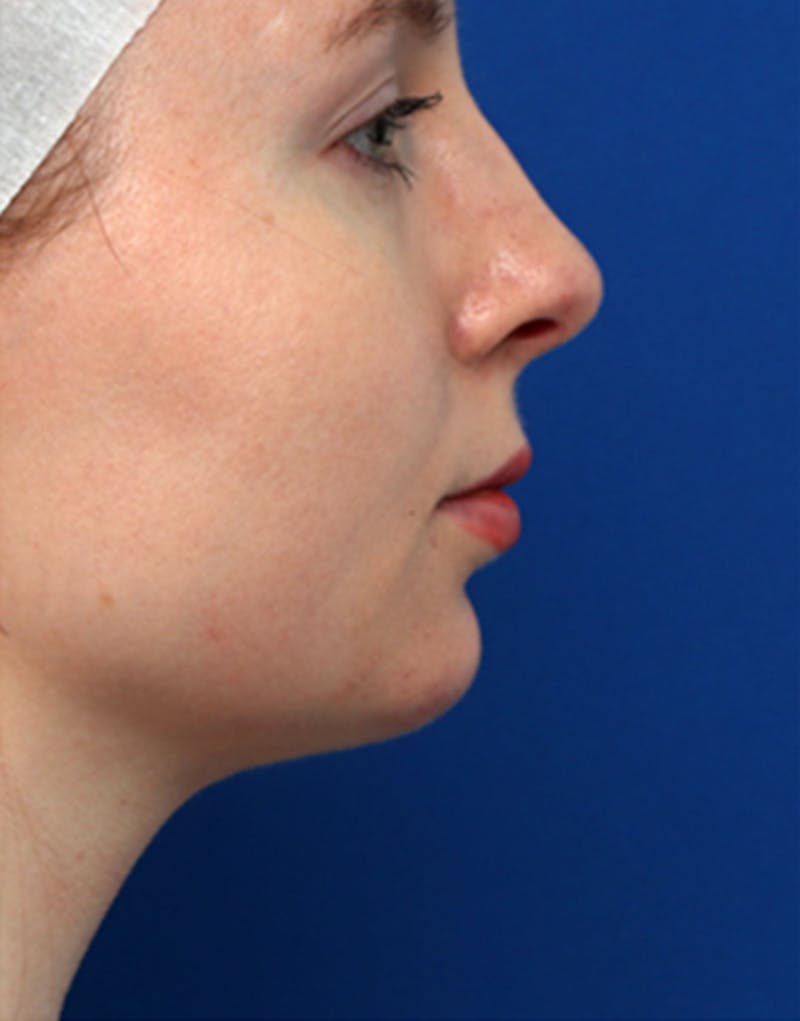 Chin Surgery Before & After Gallery - Patient 194187 - Image 2