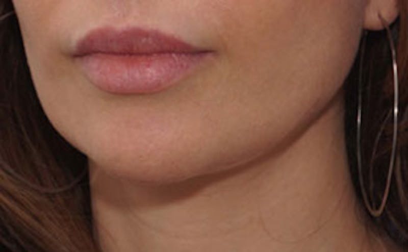 Fillers Before & After Gallery - Patient 976333 - Image 4