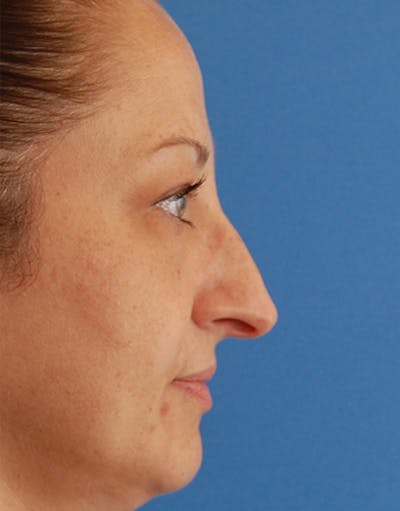 Rhinoplasty Before & After Gallery - Patient 167433 - Image 1