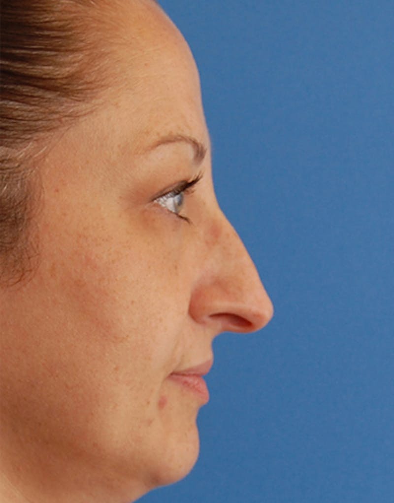 Patient cXmeakGpSNuE7zF7XQP_oA - Rhinoplasty Before & After Photos