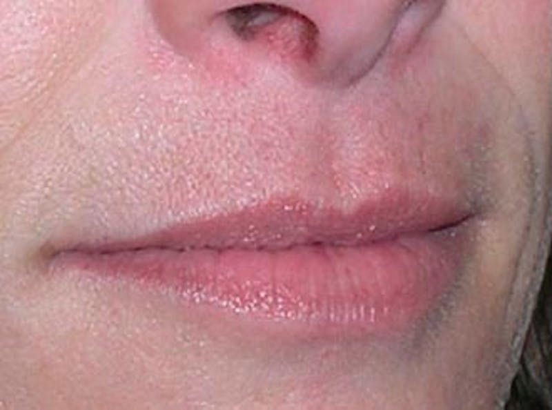 Lip Fillers Before & After Gallery - Patient 128228 - Image 3