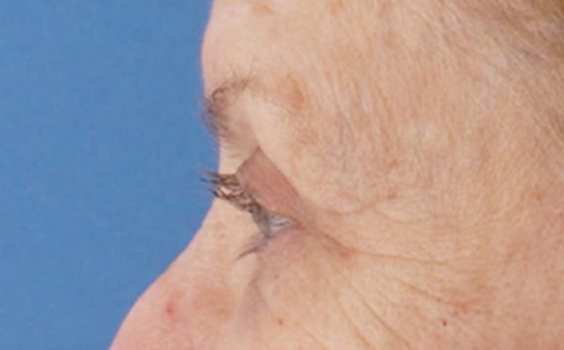 Eyelid Surgery Before & After Gallery - Patient 106125 - Image 8
