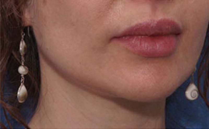 Fillers Before & After Gallery - Patient 976333 - Image 5