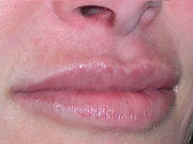 Lip Fillers Before & After Gallery - Patient 128228 - Image 4
