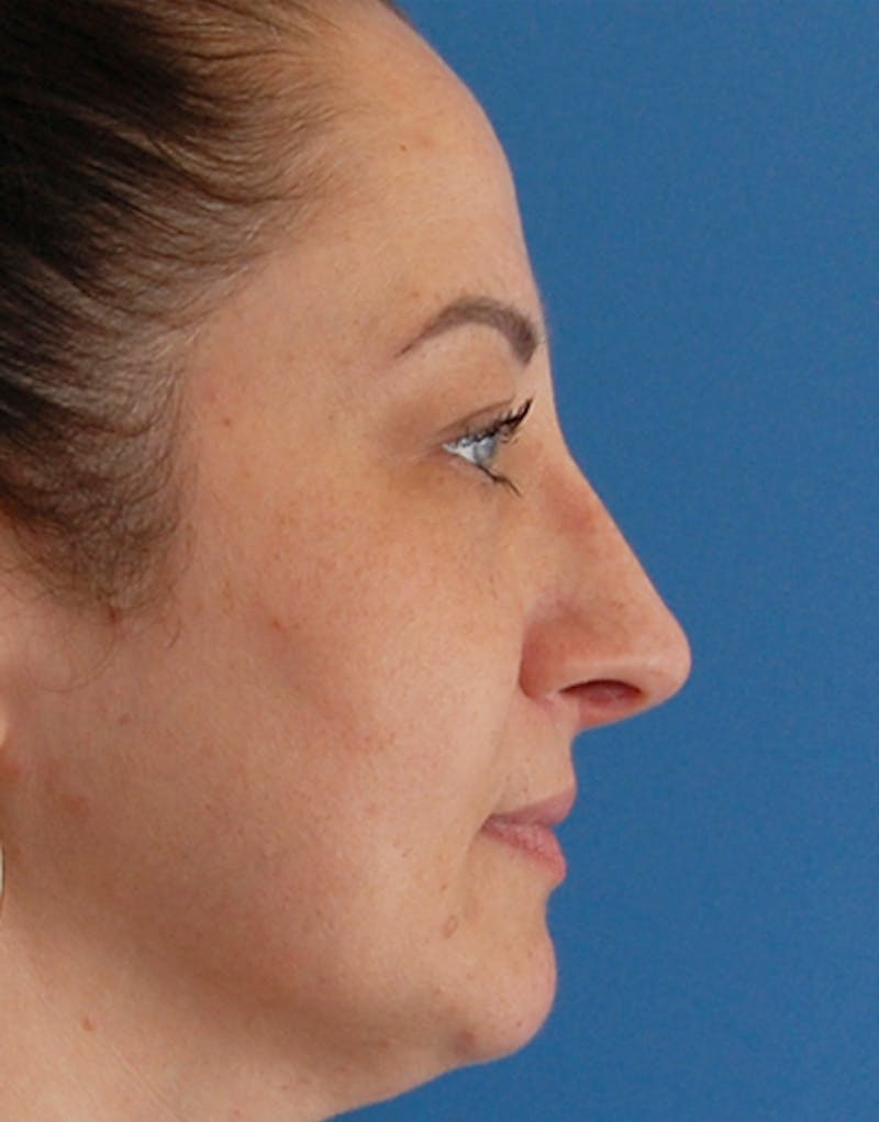 Rhinoplasty Before & After Gallery - Patient 158697 - Image 2