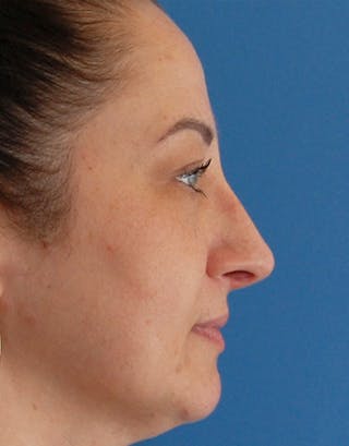 Rhinoplasty Before & After Gallery - Patient 167433 - Image 2