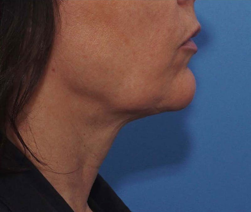 FaceTite Before & After Gallery - Patient 256615 - Image 10