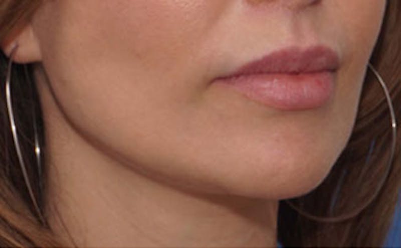 Fillers Before & After Gallery - Patient 976333 - Image 6