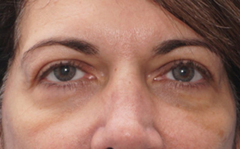 Patient VoSTj6ecSd-ihGSaLqeAtQ - Eyelid Surgery Before & After Photos