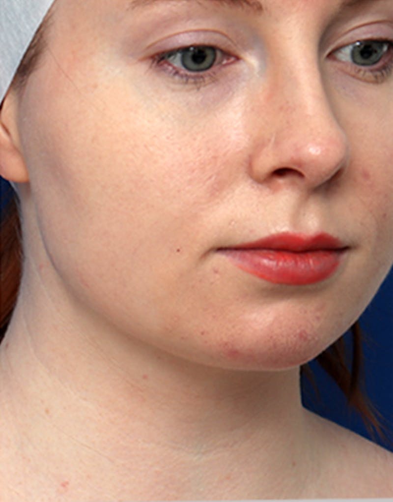 Chin Surgery Before & After Gallery - Patient 194187 - Image 4