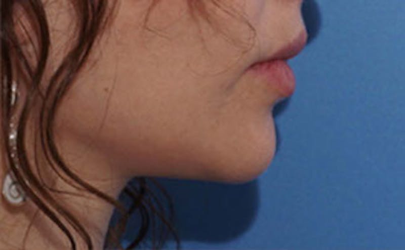 Fillers Before & After Gallery - Patient 976333 - Image 7