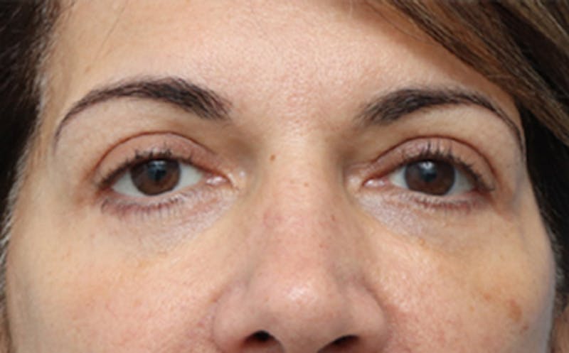 Eyelid Surgery Before & After Gallery - Patient 7334 - Image 2