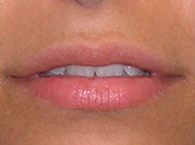 Lip Fillers Before & After Gallery - Patient 210907 - Image 1