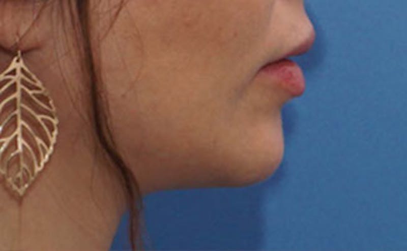 Fillers Before & After Gallery - Patient 976333 - Image 8