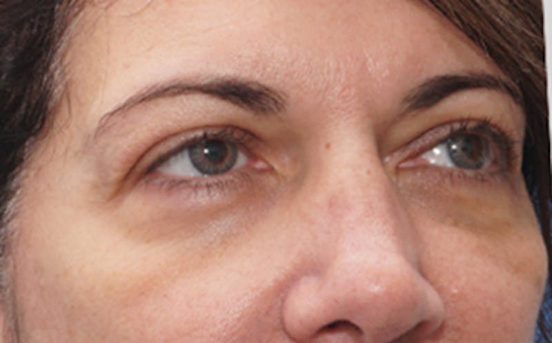 Eyelid Surgery Before & After Gallery - Patient 7334 - Image 3