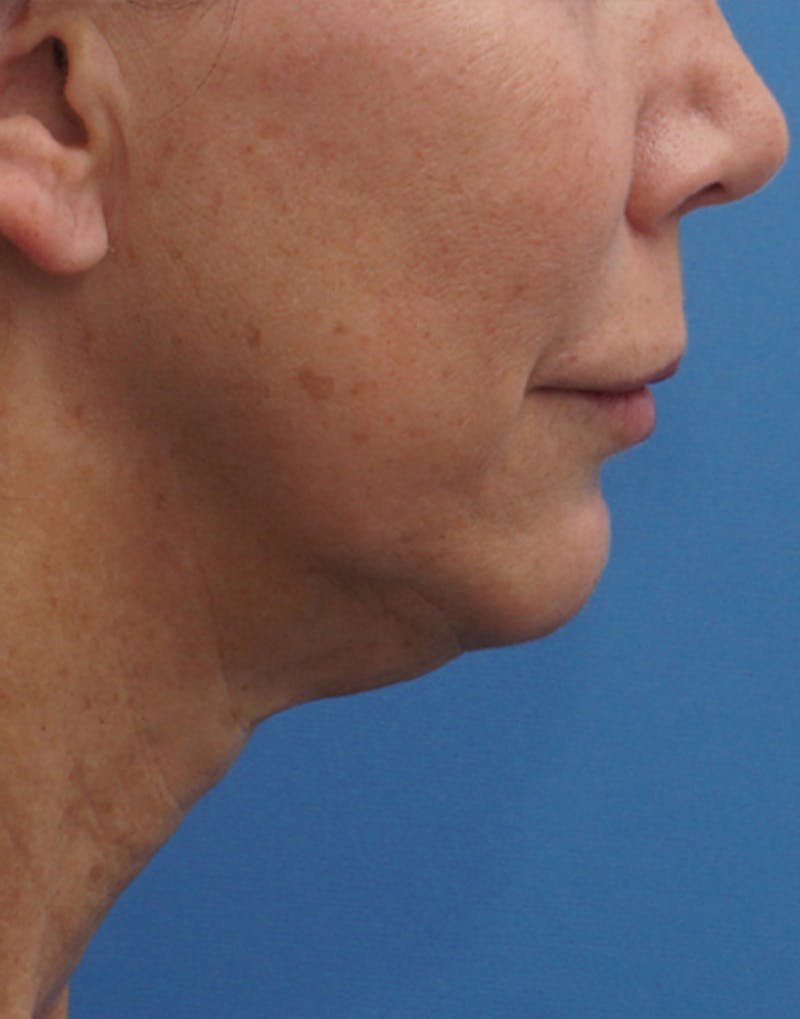 Chin Surgery Before & After Gallery - Patient 229983 - Image 1