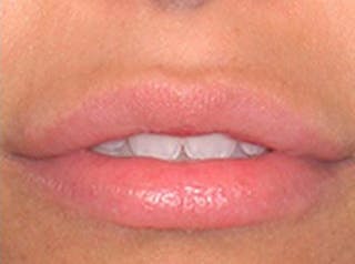 Lip Fillers Before & After Gallery - Patient 210907 - Image 2