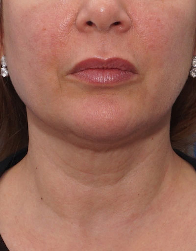 FaceTite Before & After Gallery - Patient 180927 - Image 5