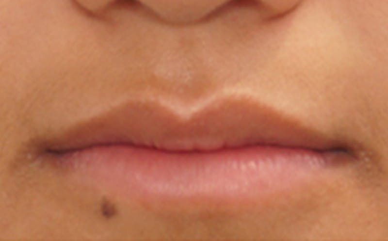 Fillers Before & After Gallery - Patient 248678 - Image 1