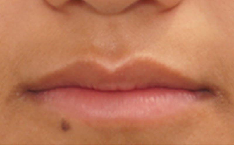 Patient G9JjtuwTQSm2Mv5Zg4eeuw - Lip Fillers Before & After Photos