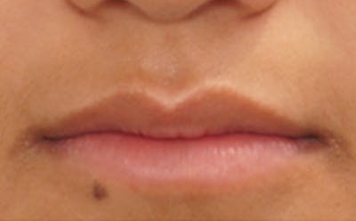 Fillers Before & After Gallery - Patient 248678 - Image 1