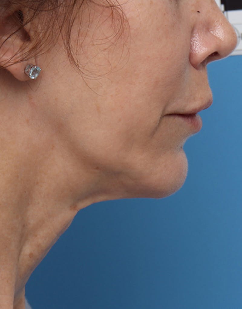 Chin Surgery Before & After Gallery - Patient 229983 - Image 2