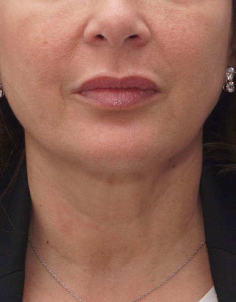 FaceTite Before & After Gallery - Patient 180927 - Image 6